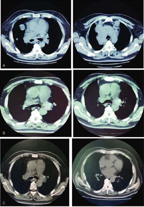 A Ct Scan Showed Right Hilar Mass With Unclear Edges Extending To The