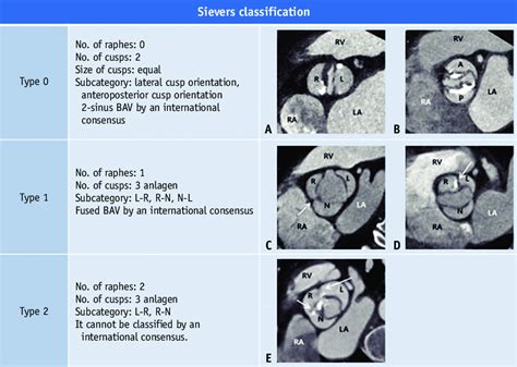 Classification Of Bicuspid Aortic Valve Bav According To The Sievers