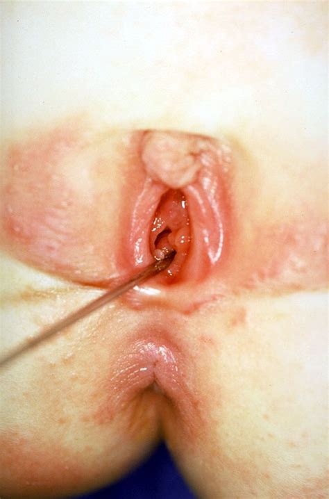 pediatric vagina
