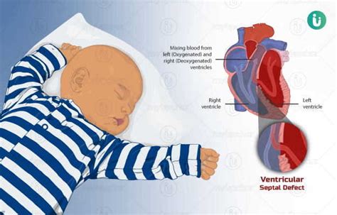 congenital heart disease defect symptoms  treatment