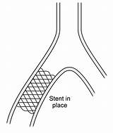 Pta Stenting Angioplasty Percutaneous Transluminal sketch template