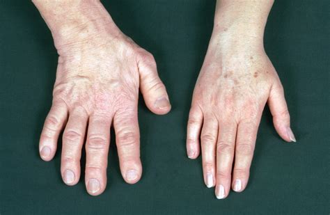 acromegaly outlook improves with better diagnostics and