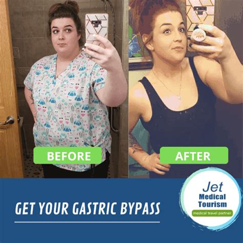 Gastric Bypass Success Stories Carole S Weight Loss
