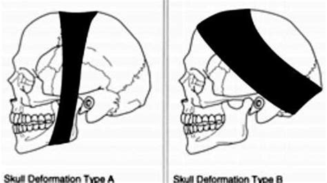 la pratica della deformazione cranica il secolo xix