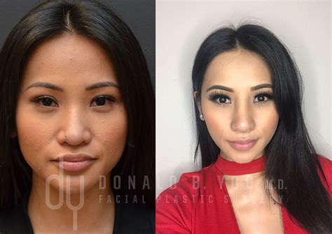 before and after revision asian rhinoplasty with rib cartilage 2 weeks post op pictures