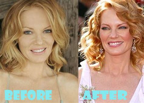Marg Helgenberger Plastic Surgery Before And After