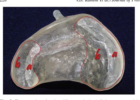 figure 1 from simplifying cleft surgery by presurgical nasoalveolar molding pnam for infant