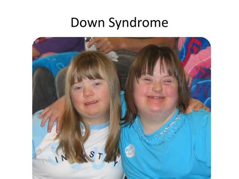Ppt Down Syndrome Trisomy 21 Powerpoint Presentation Free
