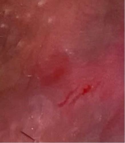 Small Cut Tear Near Vagina Sexual Health Forums Patient