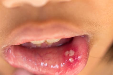 mouth ulcers embarrassing problems