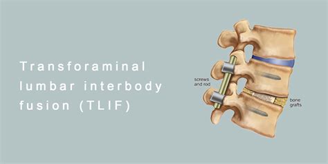 Best Tlif Surgery Doctors In Delhi Spinal Fusion Treatment India