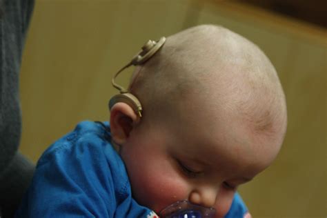 cochlear implants  children darius kohan md otologist nyc