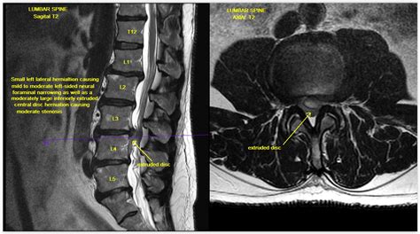 lumbar spine mri case study greater waterbury imaging center