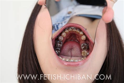 brace dental fetish porn clip