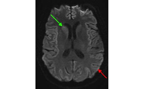brain magnetic resonance imaging mri pathology school  medicine