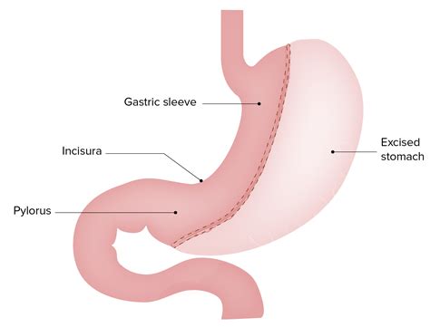 bariatric surgery concise medical knowledge