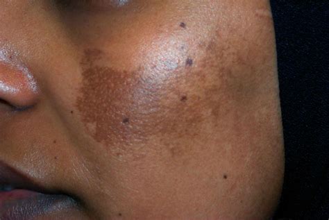 melasma    treat