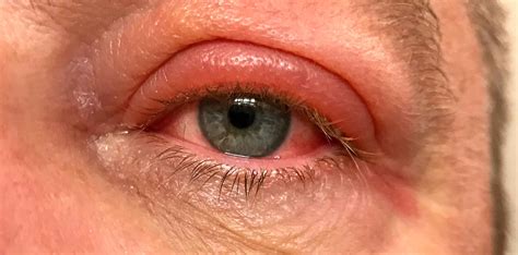 pus filled lesion   eyelid resulting   infection