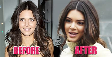 Mother Nose Best Kendall Jenner Had Nose Job Says Doc