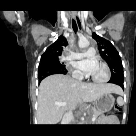 Tuberculous Mediastinal Lymphadenopathy Image