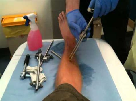 pins  leg removal youtube