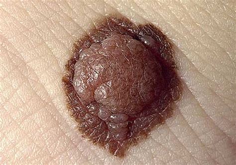 Why Moles Sometimes Develop Into Melanoma Skin Cancer Lifestyle News