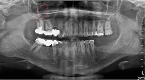 Please Take A Look At My Pictures X Ray Abscess Dentistry