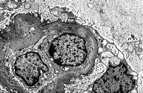 thrombotic microangiopathies basicmedical key