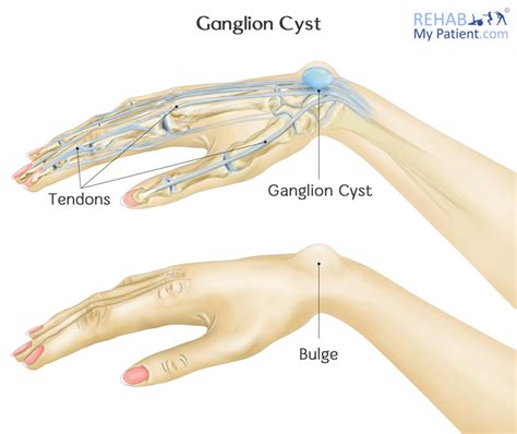 ganglion cyst rehab  patient