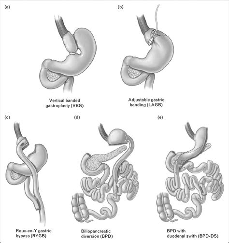 Types Of Bariatric Surgery Download Scientific Diagram