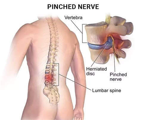 common symptoms   pinched nerve njs top orthopedic spine pain