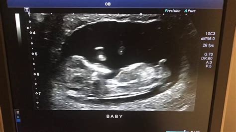11 weeks and 6 days second ultrasound youtube