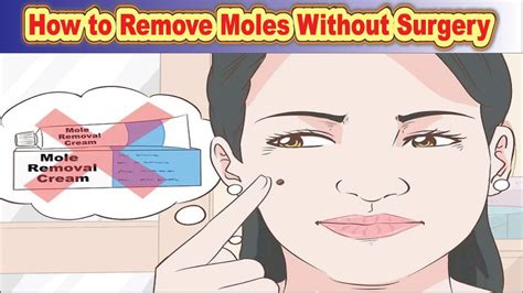 how to remove moles without surgery step by step