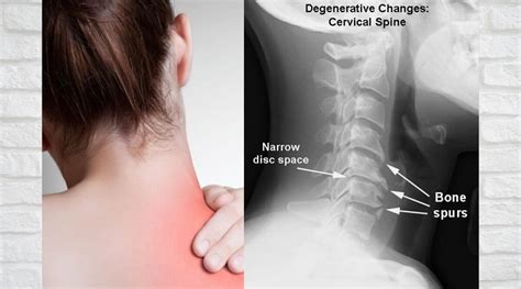 neck pain cervical spondylosis   spondylosis   treat
