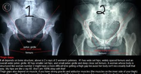 thigh gap is all about bone structure girlsaskguys