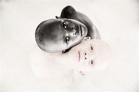 tanzanijski djecaci  albinizmom su najugrozenija djeca na svijetu cdm