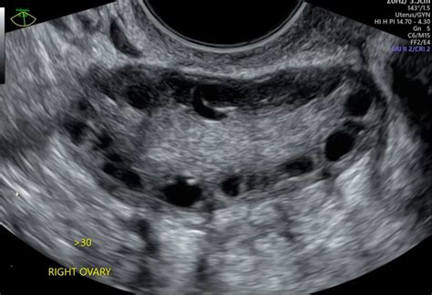 normal  polycystic ovaries ultrasound
