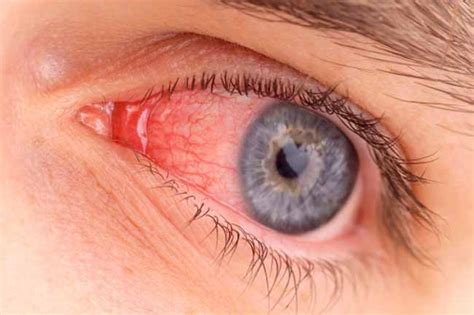 home remedies  eye infections home remedies