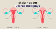 Bildergebnis für Uterus Didelphys. Größe: 193 x 100. Quelle: birlafertility.com