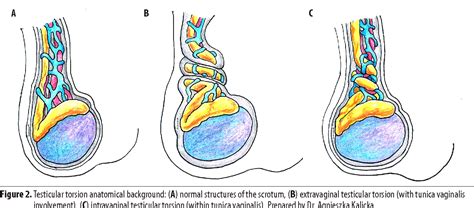 ultrasonography  extravaginal testicular torsion  neonates semantic scholar