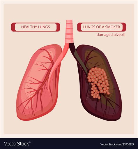 smoker lungs smoke human damage lung cancer vector image  xxx hot girl
