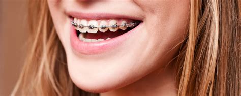 metal braces rollins petersen orthodontics gilbert az