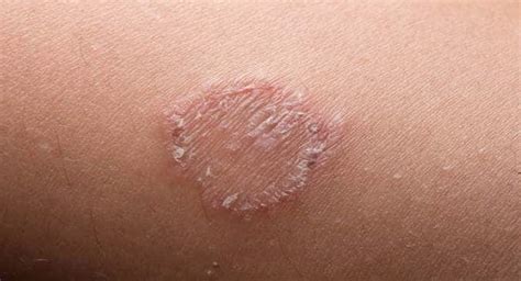 5 Common Myths About Ringworm Infections Busted Read Health Related