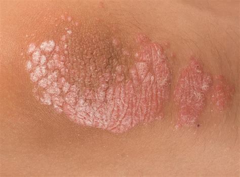 psoriasis quelques conseils pour le soigner lozzoo