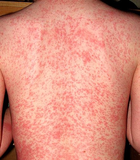 heat rash pictures treatment  types symptoms prevention