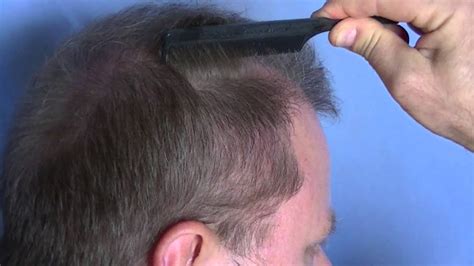 fue hair transplant video showing  visible scarring youtube