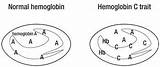 Hemoglobin Trait Disease Cell Sickle Diease Diagnosis Laboratory People Do Medical They Normal Develop Diseases Cannot Pass Later Children These sketch template