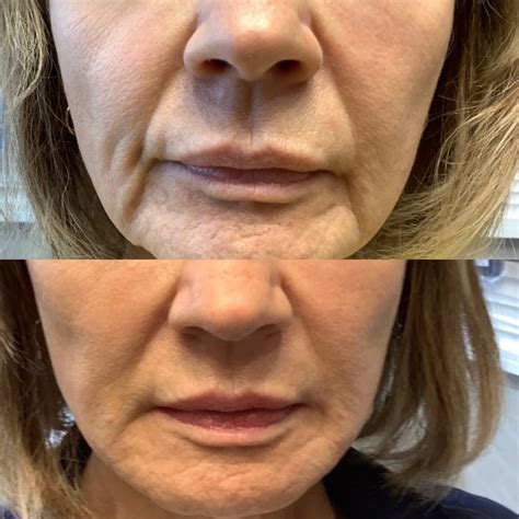 facial filler treatments altaire clinic