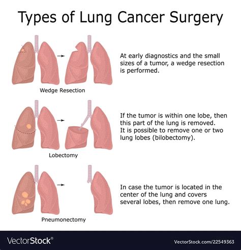 lung cancer surgery medicine  world