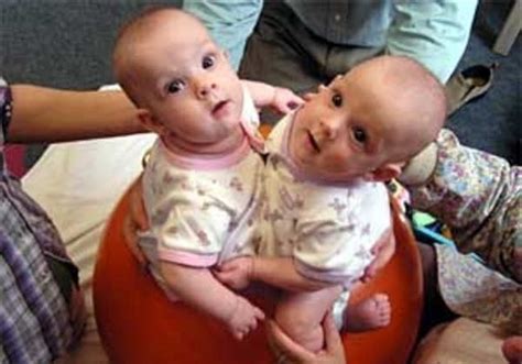 These Conjoined Twins Live An Incredible Life Proving The Skeptics